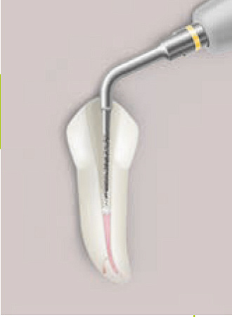 Acteon ET20D – Насадка с алмазным покрытием